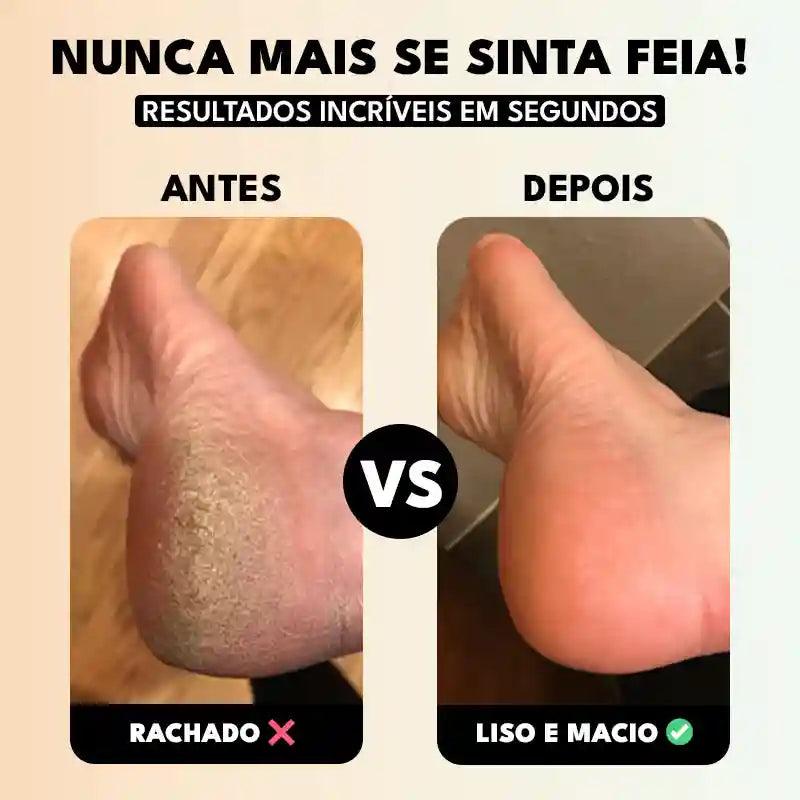 Lixa para Pés Portátil Axen (2 LIXAS DE BRINDE!)